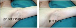  改良小切口汗腺清除术改良小切口汗腺清除术前后对比.GIF