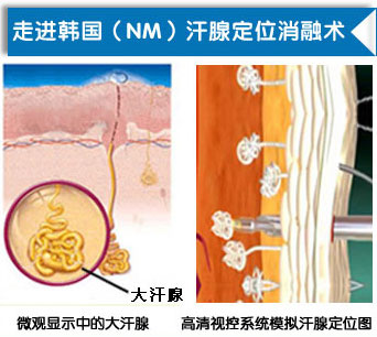  改良小切口汗腺清除术改良小切口汗腺清除术.jpg